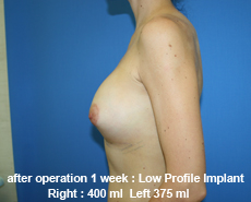plastic-surgery-breast-augmentation